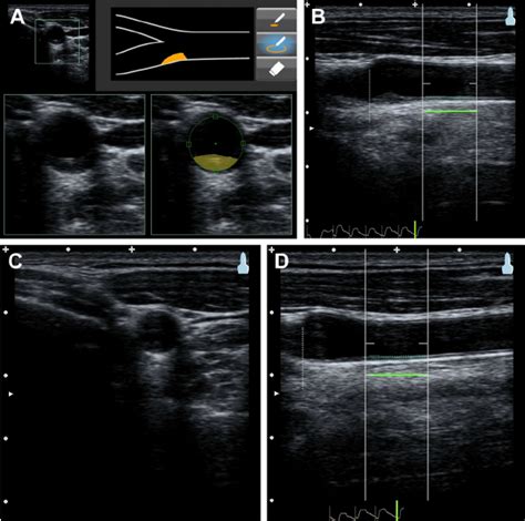 niva versus intimal thickness testing|imt thickness.